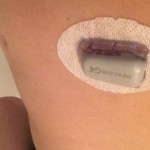 Dexcom 1