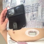 Dexcom 3